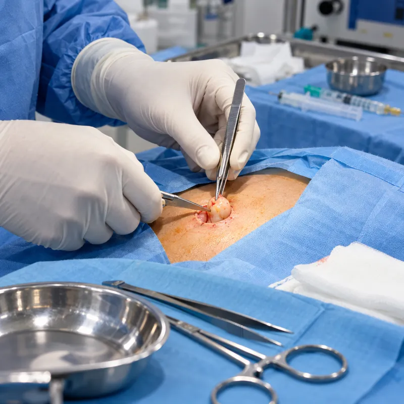 Lumps, Cysts and Lipoma – Pluto Hospital, Himatnagar